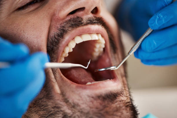 Best Emergency Wisdom Teeth Removal in Santee, CA