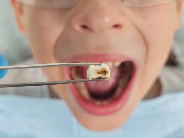Best Emergency Dental Care for Broken or Chipped Teeth in Santee, CA